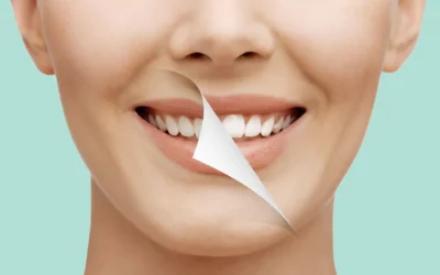 Sbiancamento dentale: consigli per un sorriso splendente
