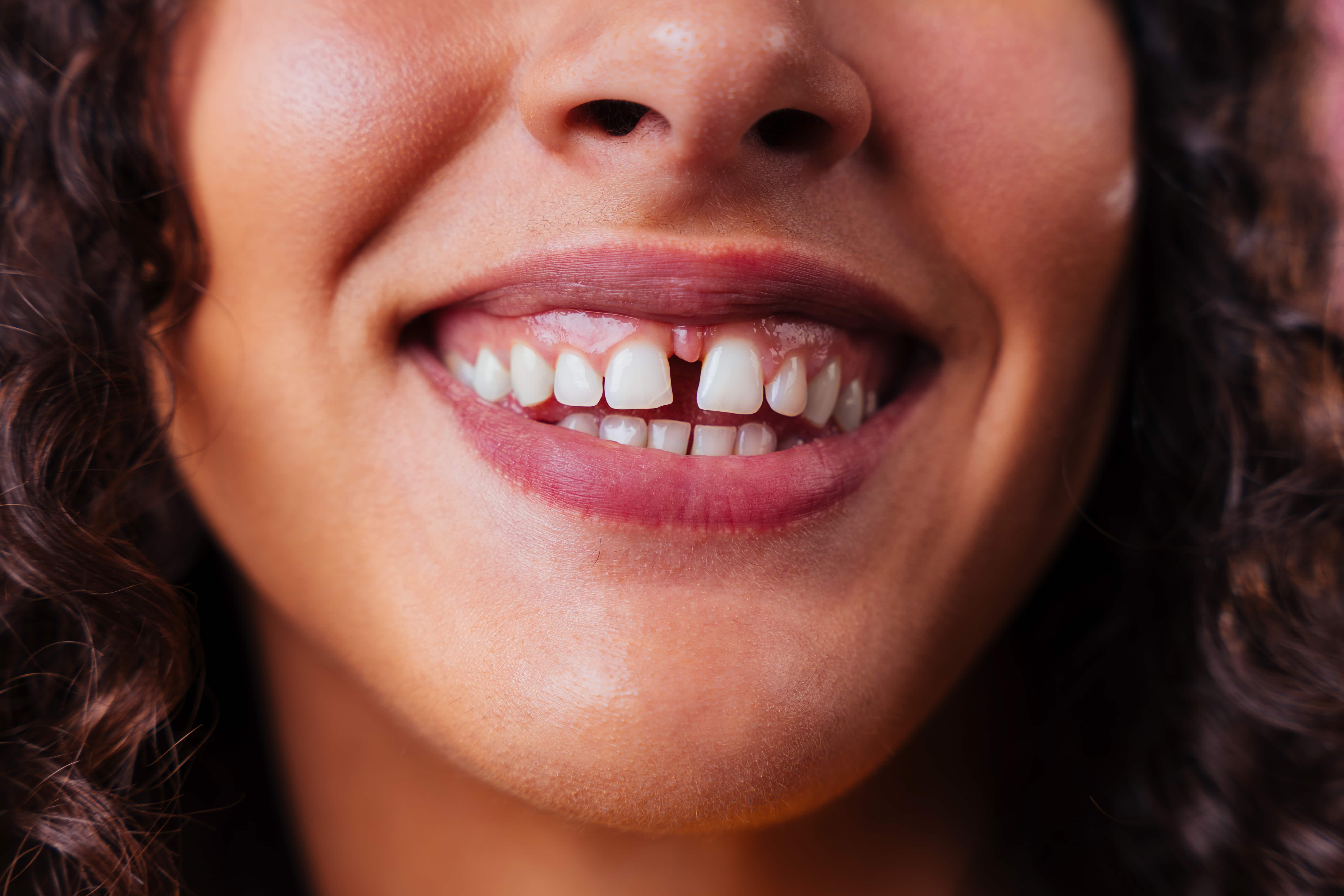 Diastema dentale: cos’è e come correggerlo in modo estetico