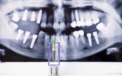 Occlusione scorretta post-impianto: sintomi e trattamento