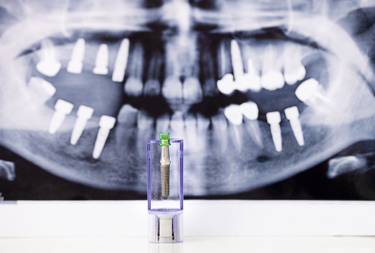 rx bocca con impianti dentali osteointegrati lastra rx sorriso con impianti dentali