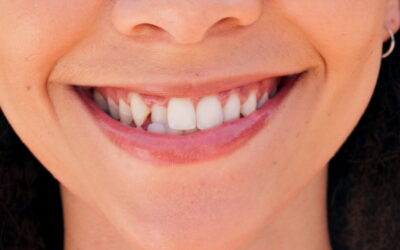 Denti storti negli adulti: meglio scegliere l’apparecchio fisso o gli allineatori trasparenti?